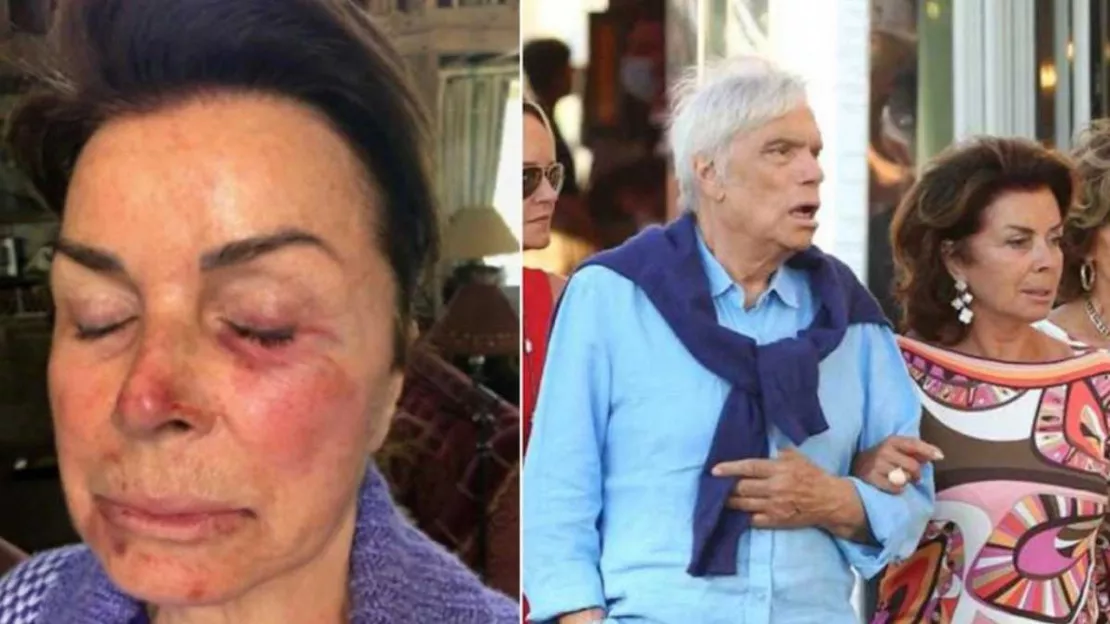Bernard Tapie et sa femme Dominique victimes d'un cambriolage très violent (photos)