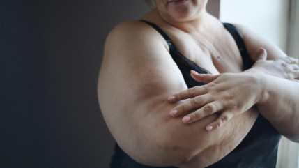 Lutte contre l'ob&eacute;sit&eacute; : une premi&egrave;re nationale au CHU de Nice